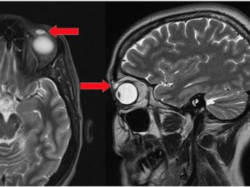 Imagen de la lentilla incrustada en el párpado de la mujer Imagen de la lentilla incrustada en el párpado de la mujer