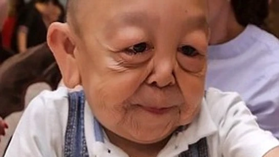 Yernar Alibekov, el niño con cara de anciano Yernar Alibekov, el niño con cara de anciano