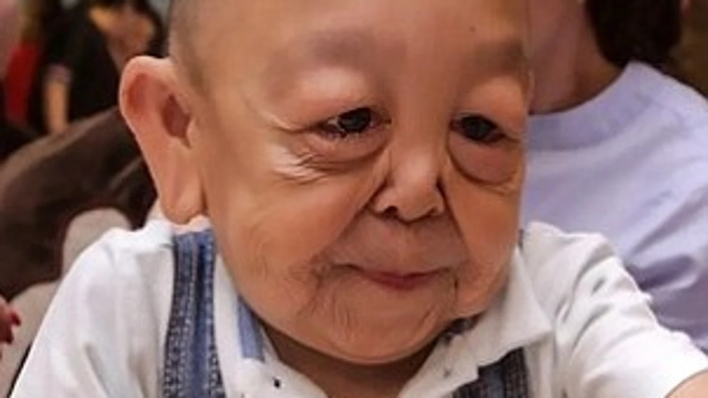 Yernar Alibekov, el niño con cara de anciano Yernar Alibekov, el niño con cara de anciano
