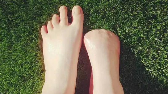 Pies de Victoria Curthoys, la australiana que perdió sus dedos Pies de Victoria Curthoys, la australiana que perdió sus dedos