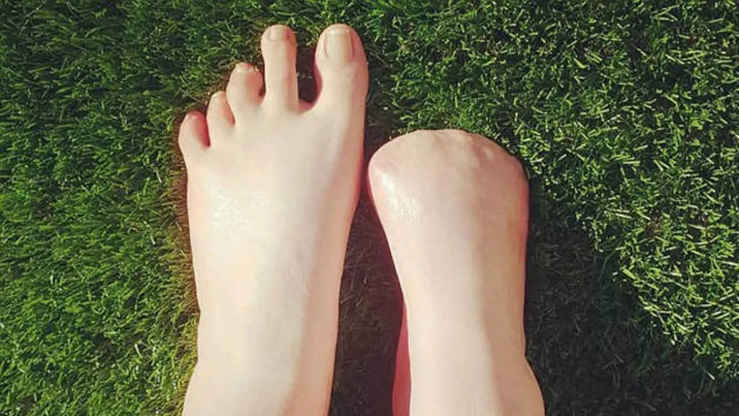 Pies de Victoria Curthoys, la australiana que perdió sus dedos Pies de Victoria Curthoys, la australiana que perdió sus dedos