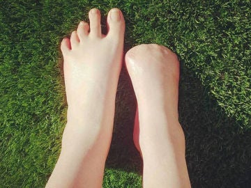 Pies de Victoria Curthoys, la australiana que perdió sus dedos Pies de Victoria Curthoys, la australiana que perdió sus dedos