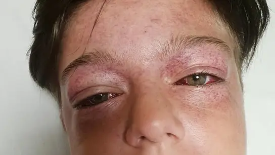 El menor tras participar en el reto viral El menor tras participar en el reto viral