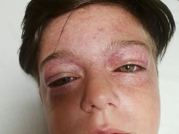 El menor tras participar en el reto viral El menor tras participar en el reto viral