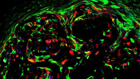 C&aacute;ncer pintado por investigadores del Instituto de Salud Carlos III