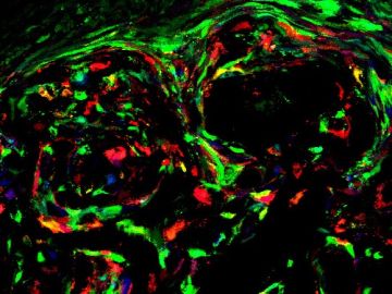 Cáncer pintado por investigadores del Instituto de Salud Carlos III Cáncer pintado por investigadores del Instituto de Salud Carlos III