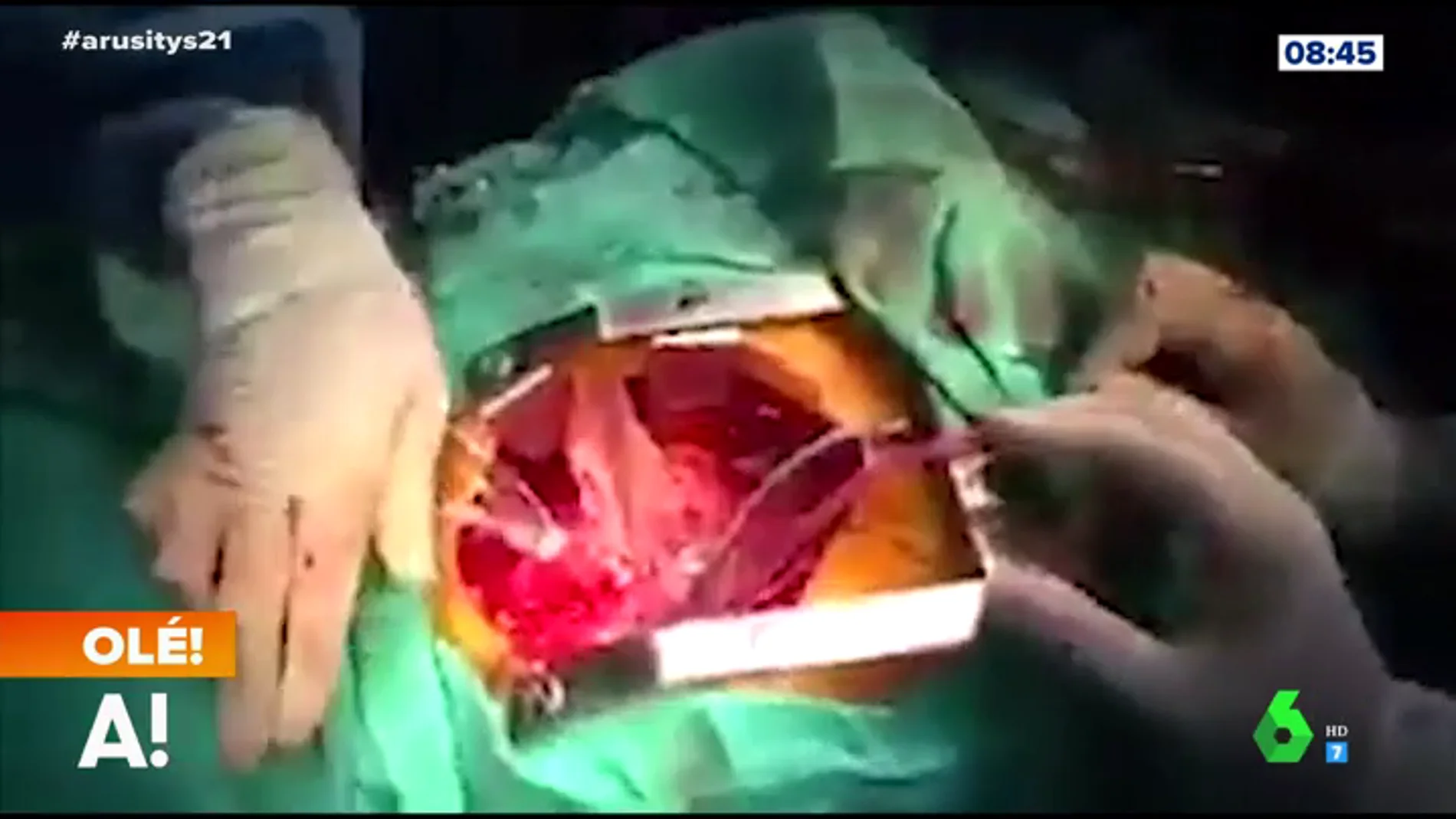 Las espectaculares imágenes de una operación a corazón abierto durante un terremoto 