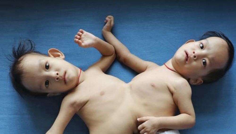 Nima y Dawa Pelden nacieron unidas por el abdomen y el tórax