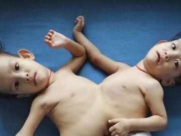 Nima y Dawa Pelden nacieron unidas por el abdomen y el tórax Nima y Dawa Pelden nacieron unidas por el abdomen y el tórax