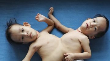 Nima y Dawa Pelden nacieron unidas por el abdomen y el tórax