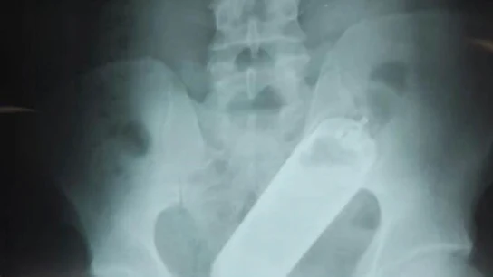 Una radiografía reveló que el hombre tenía un frasco de perfume en el recto Una radiografía reveló que el hombre tenía un frasco de perfume en el recto