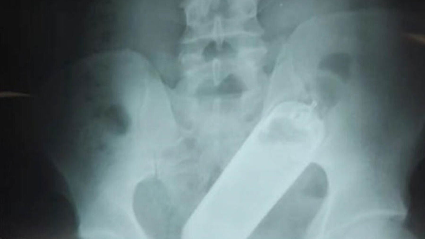 Una radiograf&iacute;a revel&oacute; que el hombre ten&iacute;a un frasco de perfume en el recto