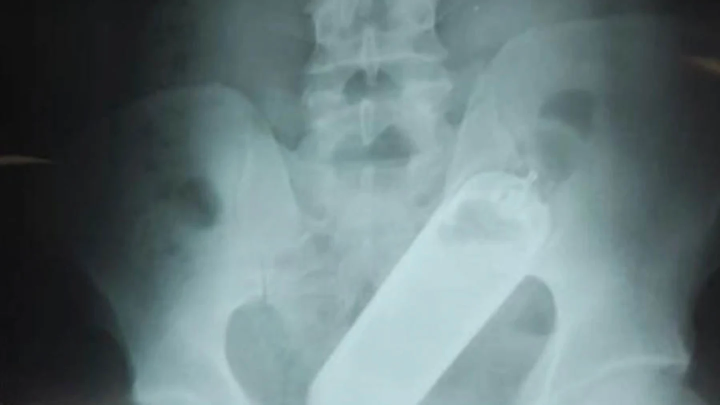 Una radiografía reveló que el hombre tenía un frasco de perfume en el recto Una radiografía reveló que el hombre tenía un frasco de perfume en el recto