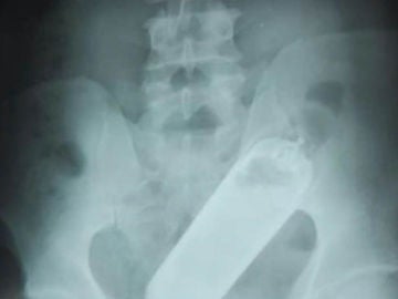 Una radiografía reveló que el hombre tenía un frasco de perfume en el recto Una radiografía reveló que el hombre tenía un frasco de perfume en el recto