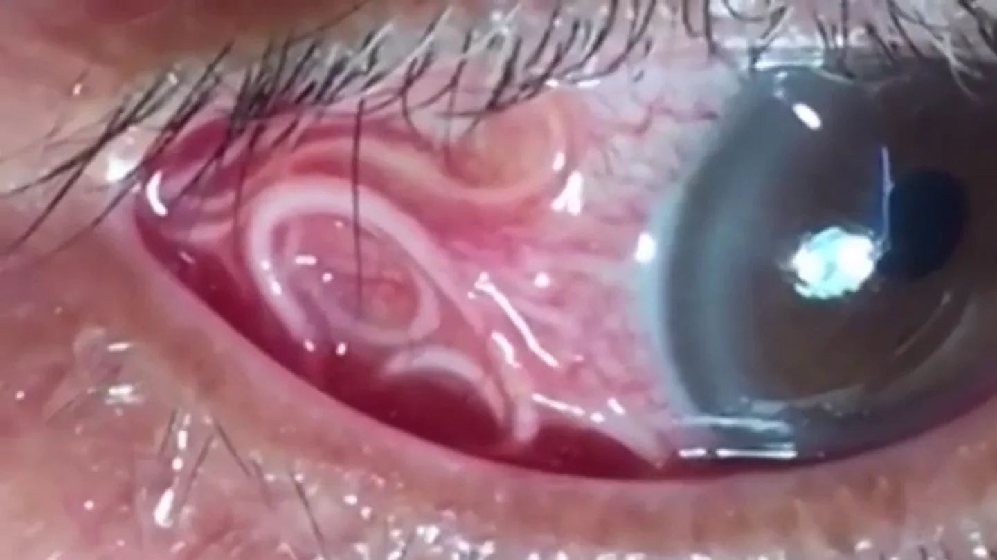 Las angustiosas imágenes que muestran la extracción de un gusano de 15 centímetros del ojo de un hombre Las angustiosas imágenes que muestran la extracción de un gusano de 15 centímetros del ojo de un hombre