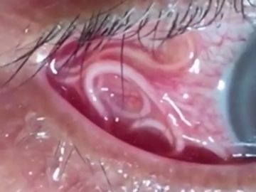 Las angustiosas imágenes que muestran la extracción de un gusano de 15 centímetros del ojo de un hombre