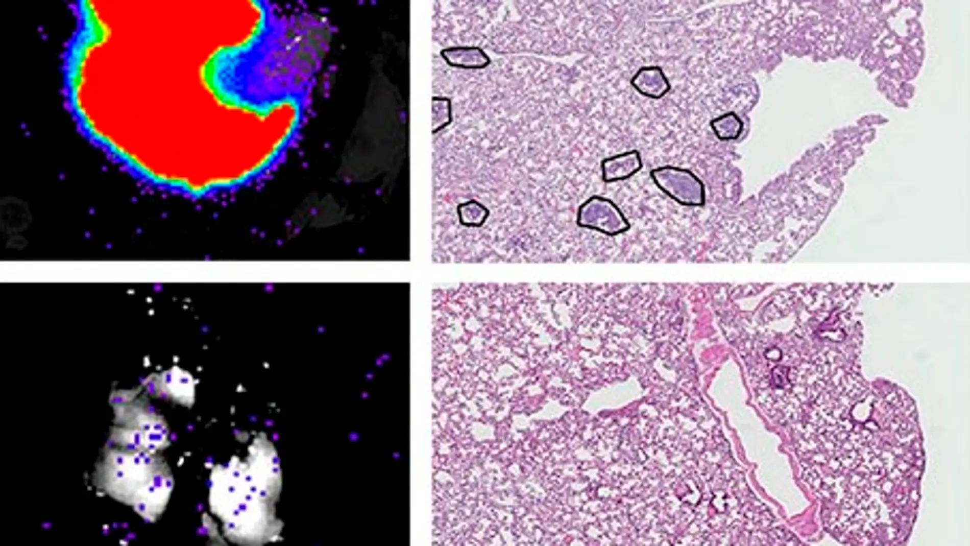 metástasis de células de cáncer de mama
