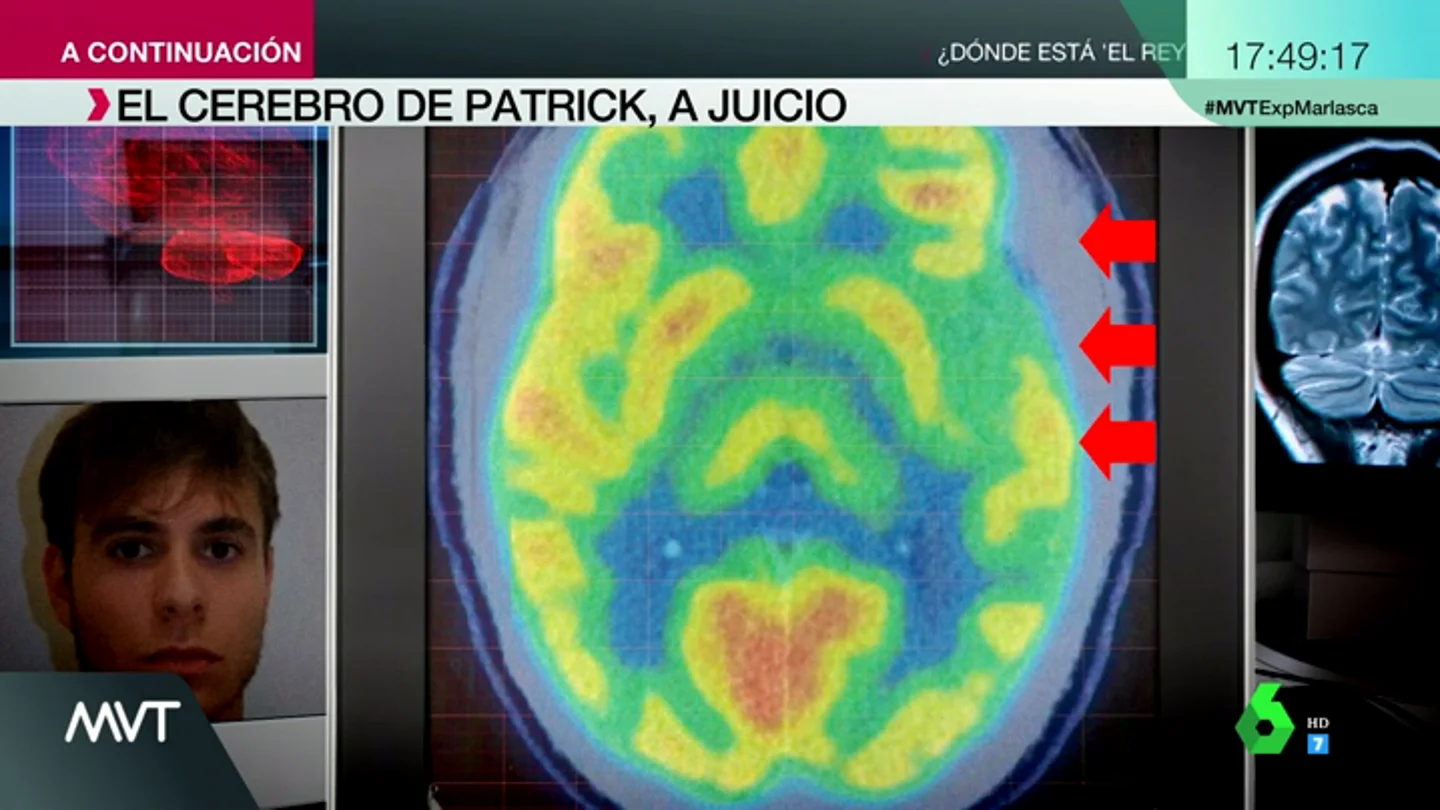 Ira incontrolable, alteraciones neurológicas y rasgos psicopáticos: así es el cerebro de Patrick Nogueira, según su defensa Ira incontrolable, alteraciones neurológicas y rasgos psicopáticos: así es el cerebro de Patrick Nogueira, según su defensa