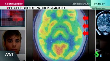 Ira incontrolable, alteraciones neurológicas y rasgos psicopáticos: así es el cerebro de Patrick Nogueira, según su defensa
