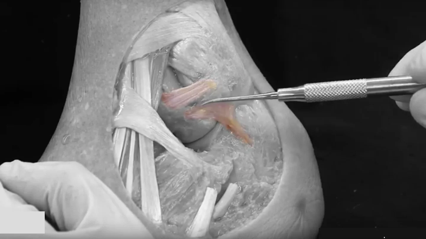 Ligamento descubierto por la Universidad de Barcelona Ligamento descubierto por la Universidad de Barcelona