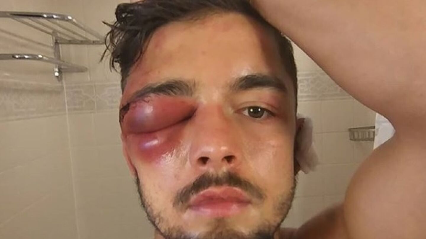 La lesi&oacute;n que obliga a retirarse del mundial superligero a Anthony Yigit