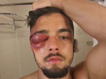 La lesión que obliga a retirarse del mundial superligero a Anthony Yigit La lesión que obliga a retirarse del mundial superligero a Anthony Yigit