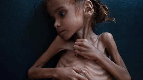 Muere la niña de siete años que puso rostro al drama de la guerra de Yemen Muere la niña de siete años que puso rostro al drama de la guerra de Yemen