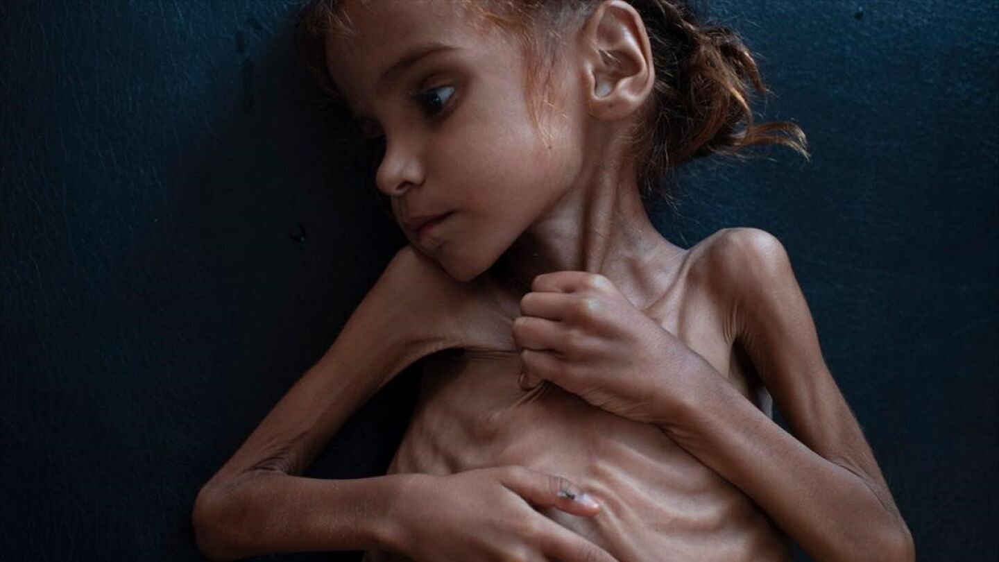 Muere la ni&ntilde;a de siete a&ntilde;os que puso rostro al drama de la guerra de Yemen