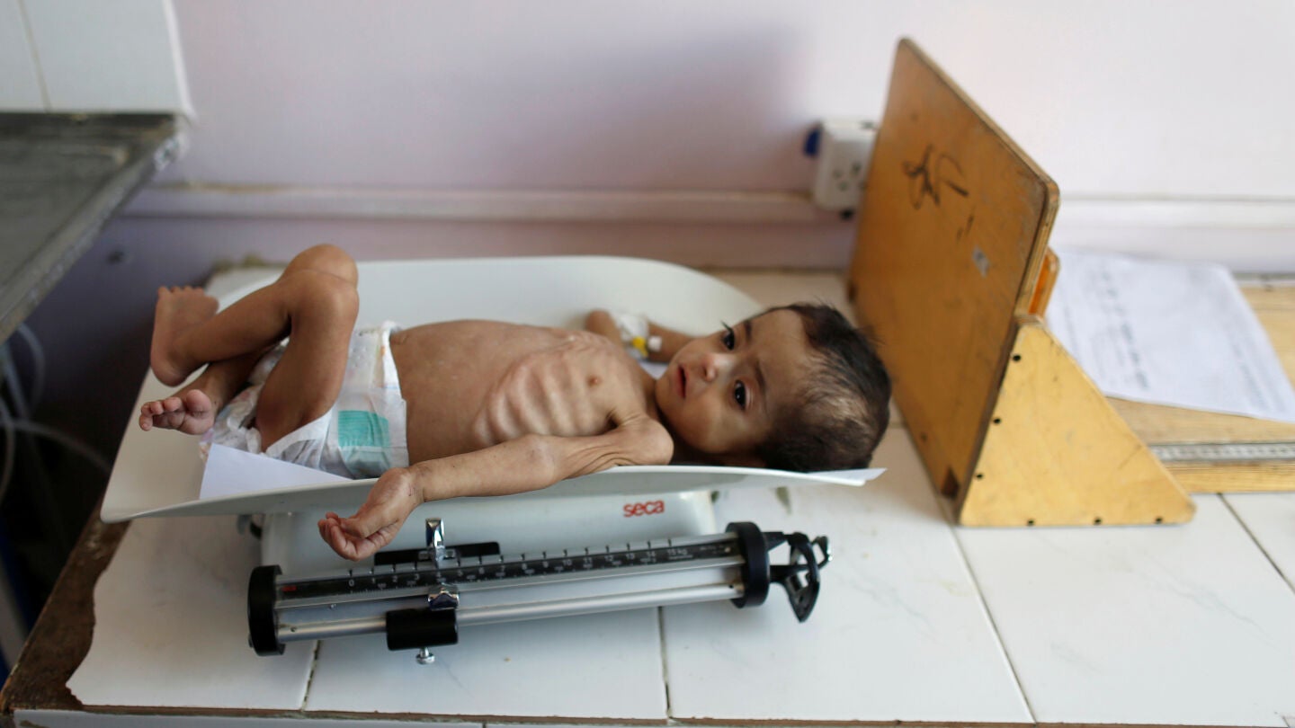 Un ni&ntilde;o desnutrido en Yemen