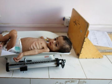 Un niño desnutrido en Yemen Un niño desnutrido en Yemen