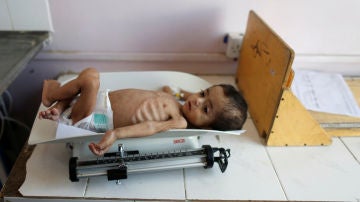 Un niño desnutrido en Yemen