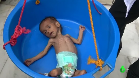 La hambruna en Yemen, causante de la muerte de 85.000 niños La hambruna en Yemen, causante de la muerte de 85.000 niños