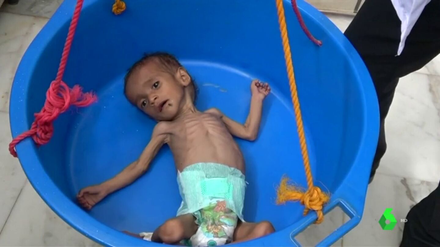 La hambruna en Yemen, causante de la muerte de 85.000 ni&ntilde;os