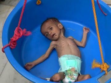 La hambruna en Yemen, causante de la muerte de 85.000 niños La hambruna en Yemen, causante de la muerte de 85.000 niños