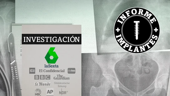 Informe Implantes Informe Implantes