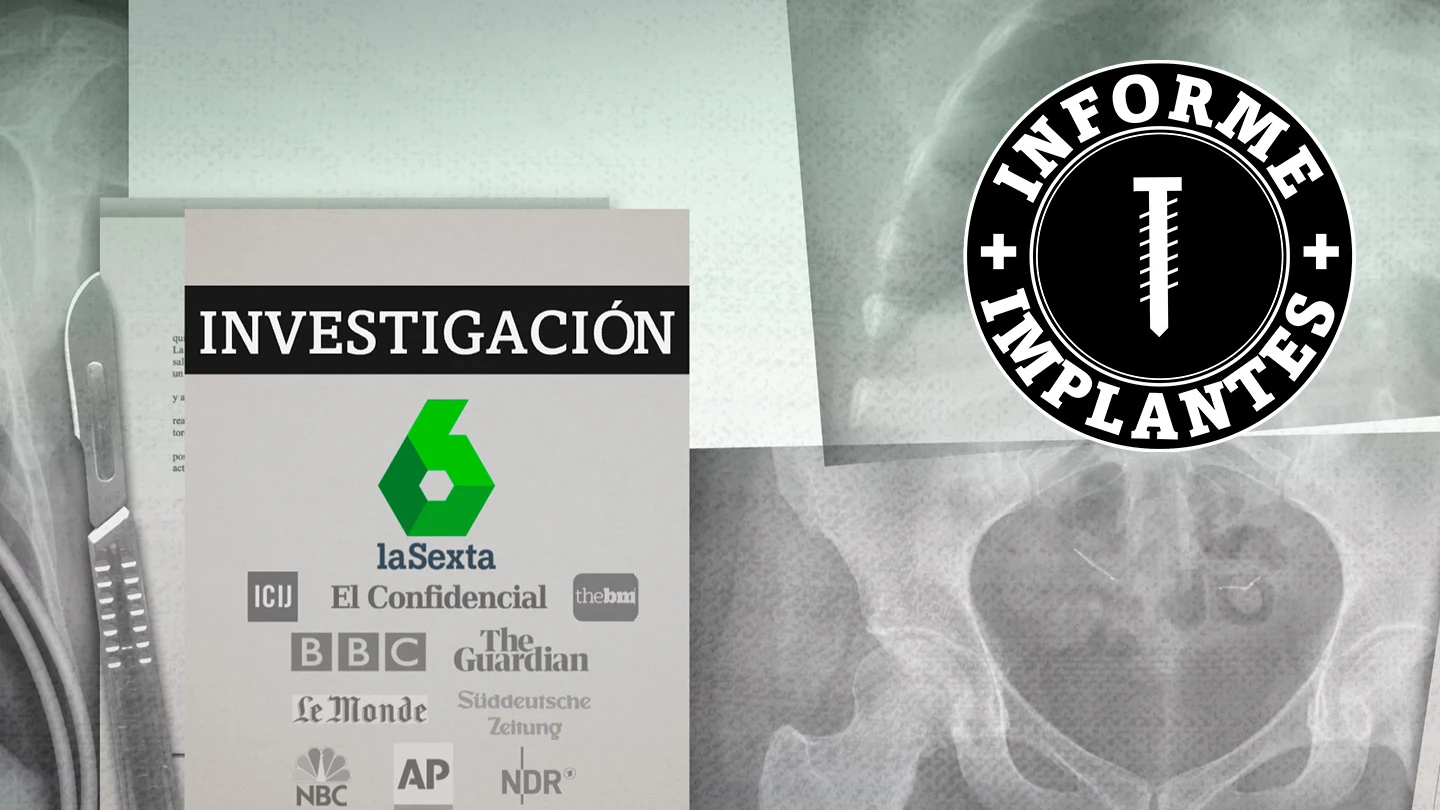 Informe Implantes Informe Implantes