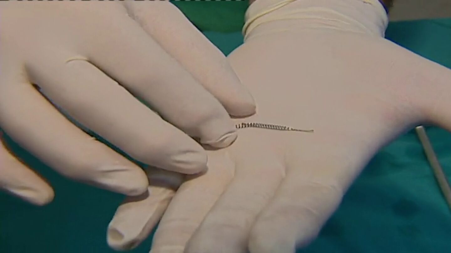 Amanecer y ocaso de Essure: cronolog&iacute;a de un anticonceptivo fallido