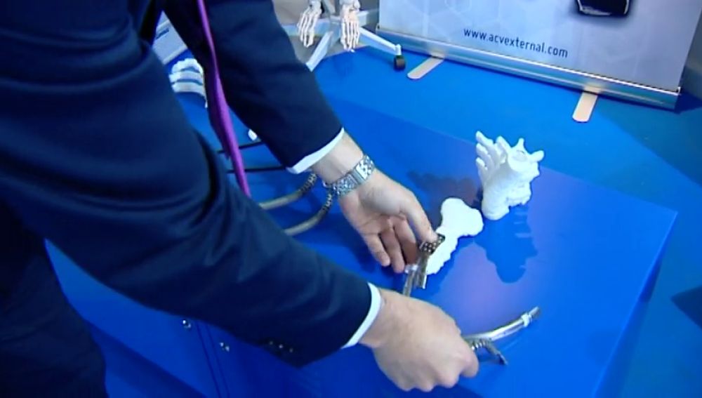 implantes con problemas la sexta