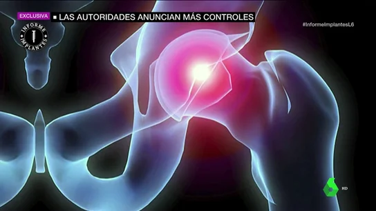 La UE admite fallos en el control de los implantes: reforzará el sistema y creará una base de datos para toda Europa de aquí a 2020 La UE admite fallos en el control de los implantes: reforzará el sistema y creará una base de datos para toda Europa de aquí a 2020