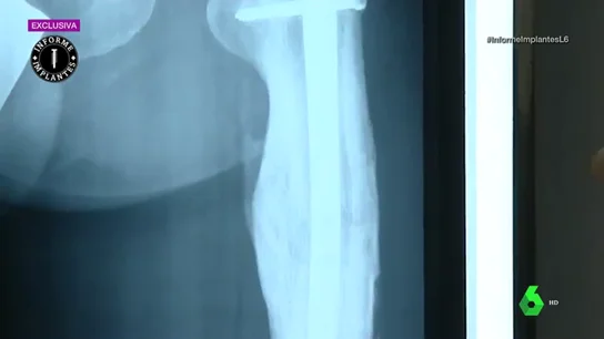 Imagen de la radiografía de un implante sanitario Imagen de la radiografía de un implante sanitario
