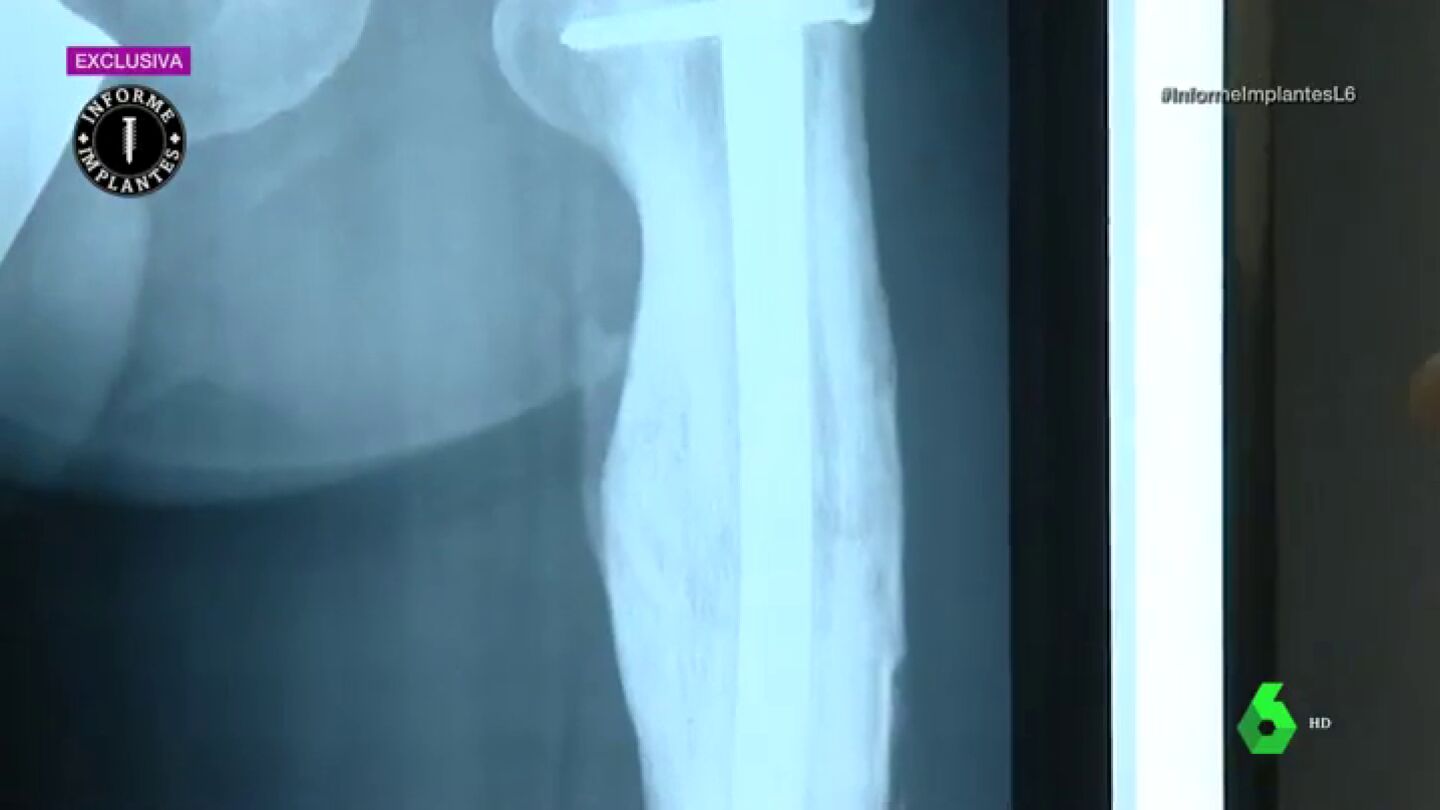 Imagen de la radiograf&iacute;a de un implante sanitario