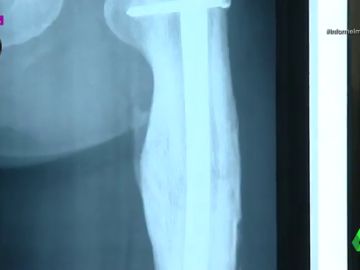 Imagen de la radiografía de un implante sanitario Imagen de la radiografía de un implante sanitario