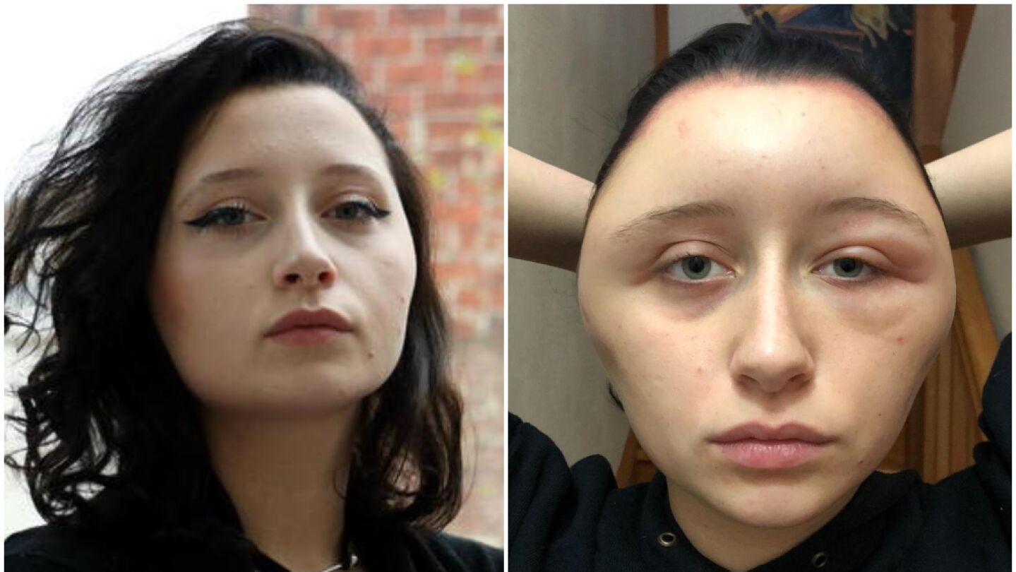 Imagen de la joven con la cabeza deformada tras te&ntilde;irse el pelo