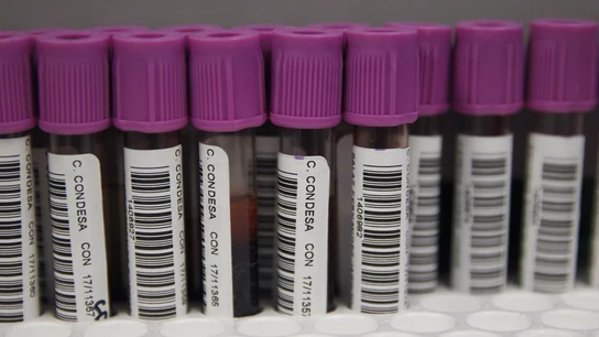 Muestras para la prueba de VIH Muestras para la prueba de VIH