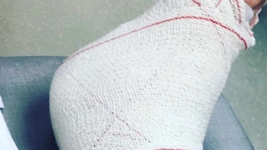 Manuela Carmena se lesiona el tobillo Manuela Carmena se lesiona el tobillo