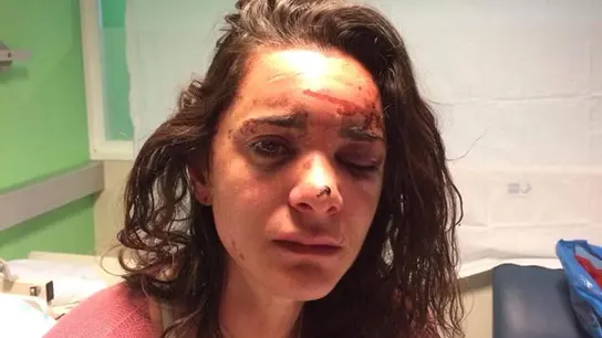Andrea sufrió graves heridas en un ojo Andrea sufrió graves heridas en un ojo