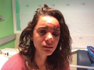 Andrea sufrió graves heridas en un ojo Andrea sufrió graves heridas en un ojo