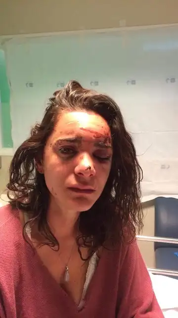 La nariz rota, moratones y arañazos tras sufrir una violación La nariz rota, moratones y arañazos tras sufrir una violación