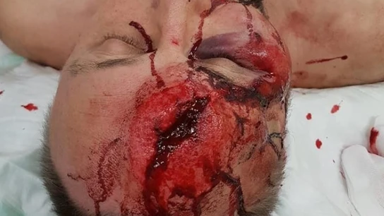 Agresión a un líder de Alternativa por Alemania Agresión a un líder de Alternativa por Alemania