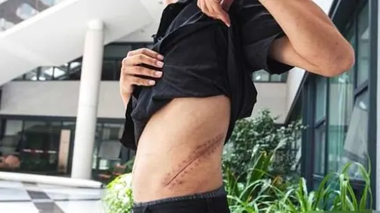 Xiao Wang muestra su cicatriz. Xiao Wang muestra su cicatriz.